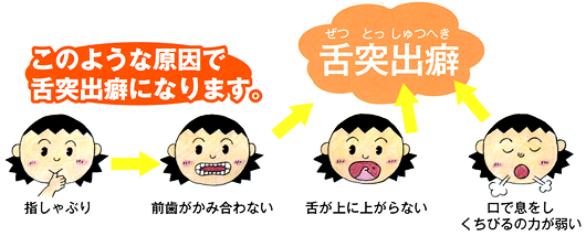 舌吐出壁